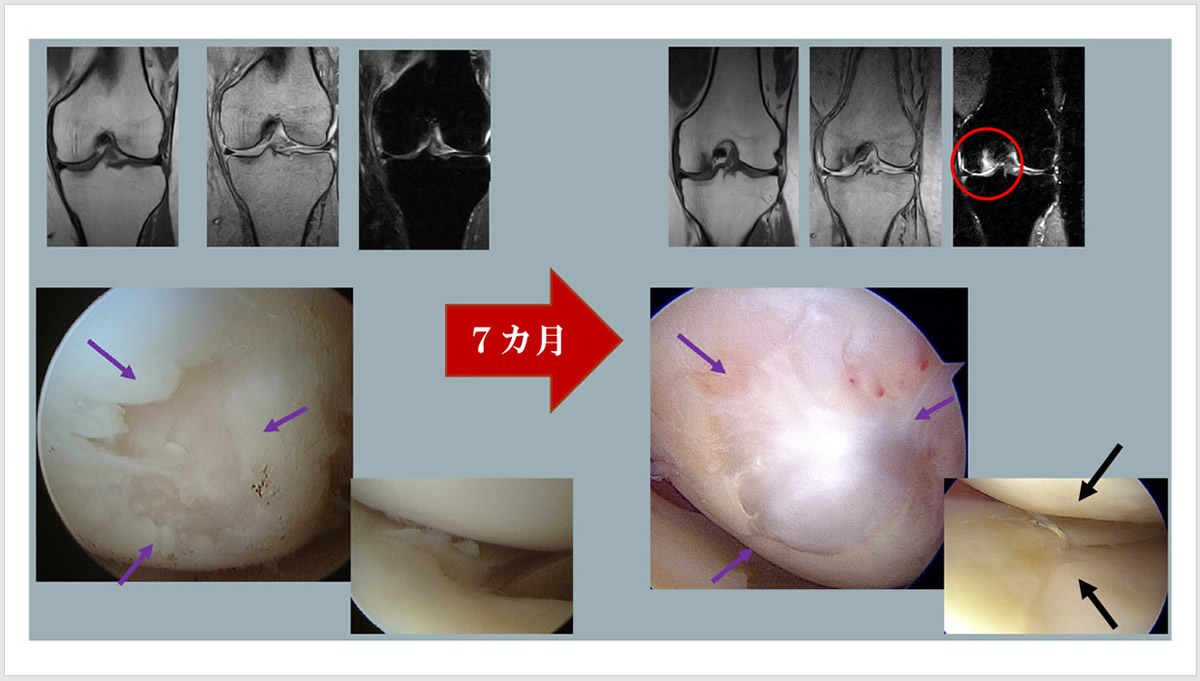 外傷性の軟骨欠損を伴っていた半月板修復症例