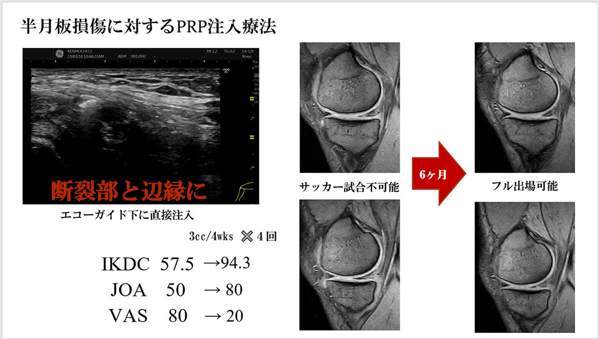 PRP投与のサイクル