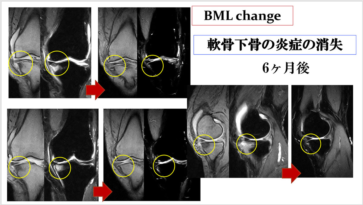 軟骨下骨の炎症の消失