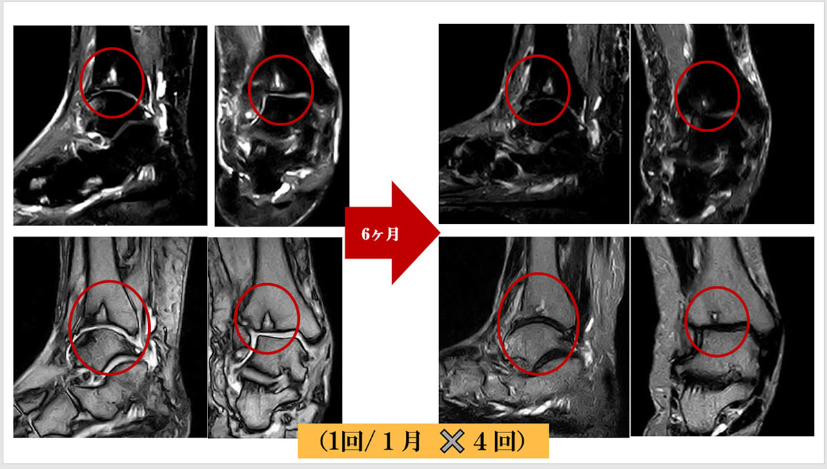 月1回計4回のLR-PRPを投与後の例