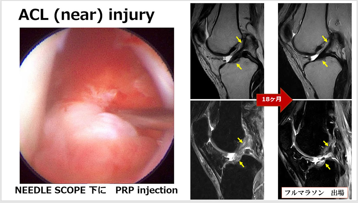 ニードルスコープを使ってACLに直接狙った部位に注入