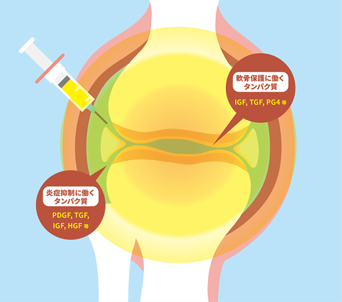 ACP PRP療法の解説画像